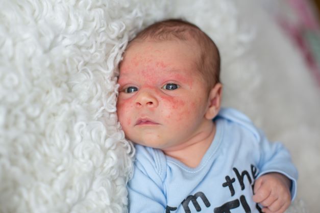 Bebis liten med eczema